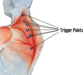 trigger-point-injections